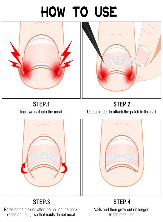 مايتيز 60 قطعة من شرائط تصحيح الأظافر الغائرة، دعامة لتصحيح الأظافر الغائرة، مشبك لتقويم الأظافر، رقعة لتصحيح الأظافر المنحنية، مناسبة للنساء والرجال، للعناية بالقدم، بنمطين - Image 5